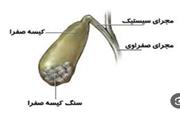 این نشانه‌ها علامت مشکلات کیسه صفرا است +مراجعه به دکتر